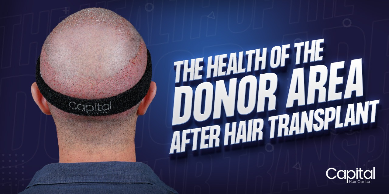 The Health of Donor Area After Hair Transplant