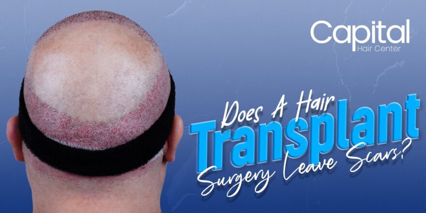 Does A Hair Transplant Surgery Leave Scars?